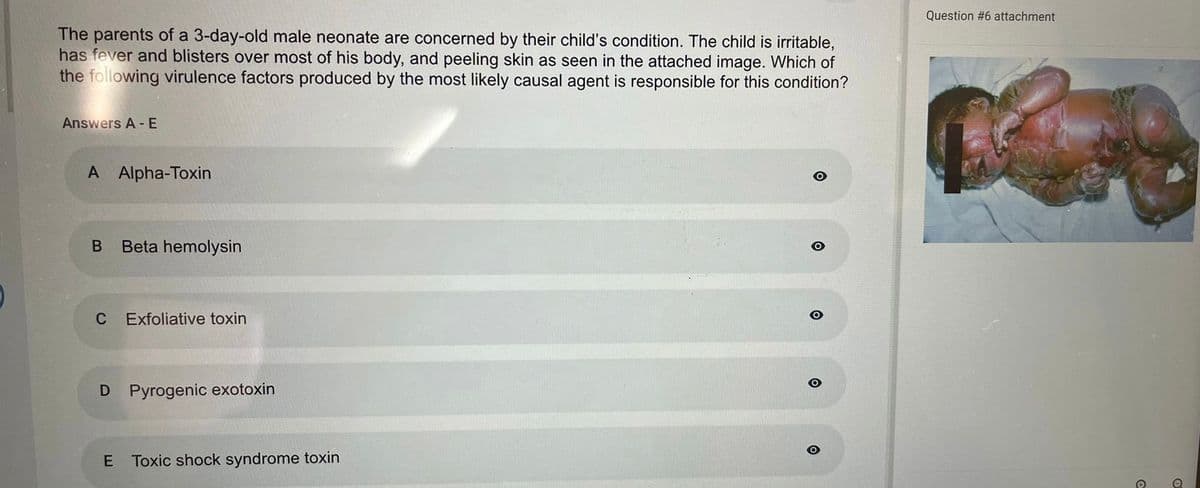 The parents of a 3-day-old male neonate are concerned by their child's condition. The child is irritable,
has fever and blisters over most of his body, and peeling skin as seen in the attached image. Which of
the following virulence factors produced by the most likely causal agent is responsible for this condition?
Answers A - E
A Alpha-Toxin
B Beta hemolysin
C
Exfoliative toxin
D Pyrogenic exotoxin
E Toxic shock syndrome toxin
O
Question #6 attachment
O
.0