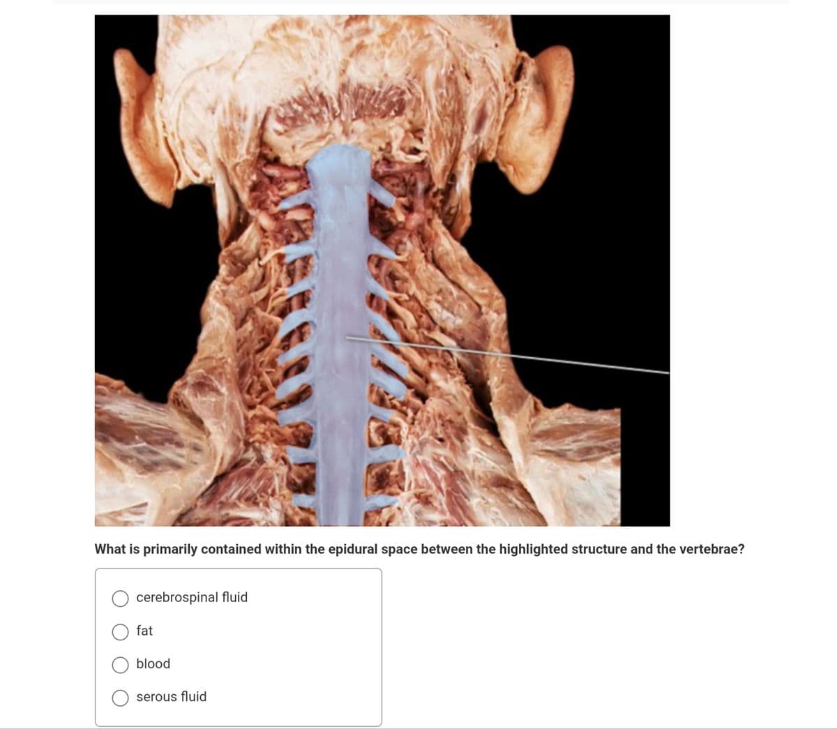 What is primarily contained within the epidural space between the highlighted structure and the vertebrae?
cerebrospinal fluid
fat
blood
serous fluid