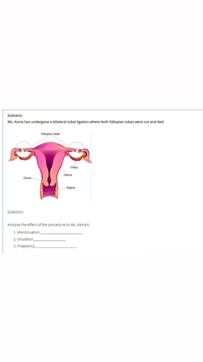 Scenario:
Ms. Asma has undergone a bilateral tubal ligation where both fallopian tubes were cut and tied.
Fallopian tubes
Ovary
Uterus
Cervix-
Vagina
Question:
Analyze the effect of the procedure to Ms. Asma's:
1. Menstruation
2. Ovulation
3. Pregnancy.
