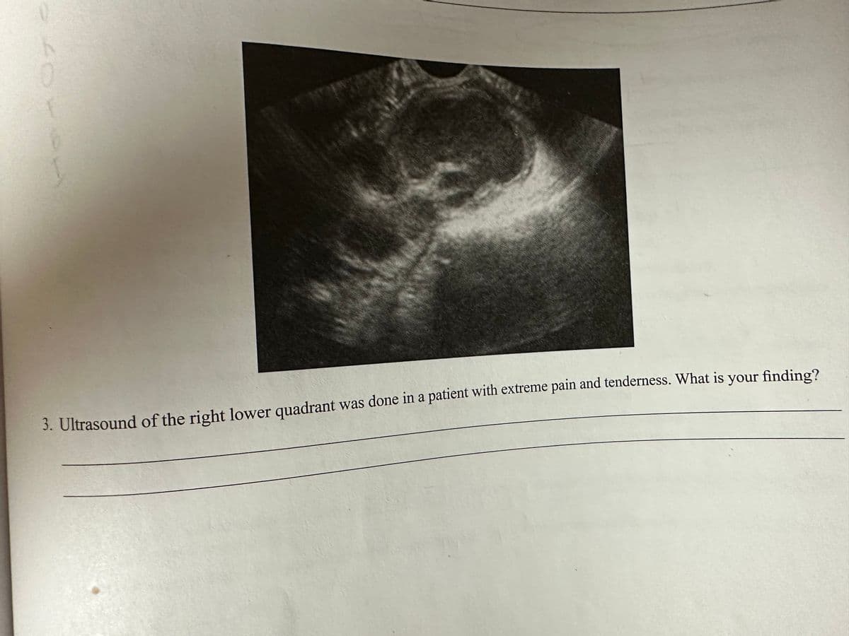 40-
3. Ultrasound of the right lower quadrant was done in a patient with extreme pain and tenderness. What is your finding?