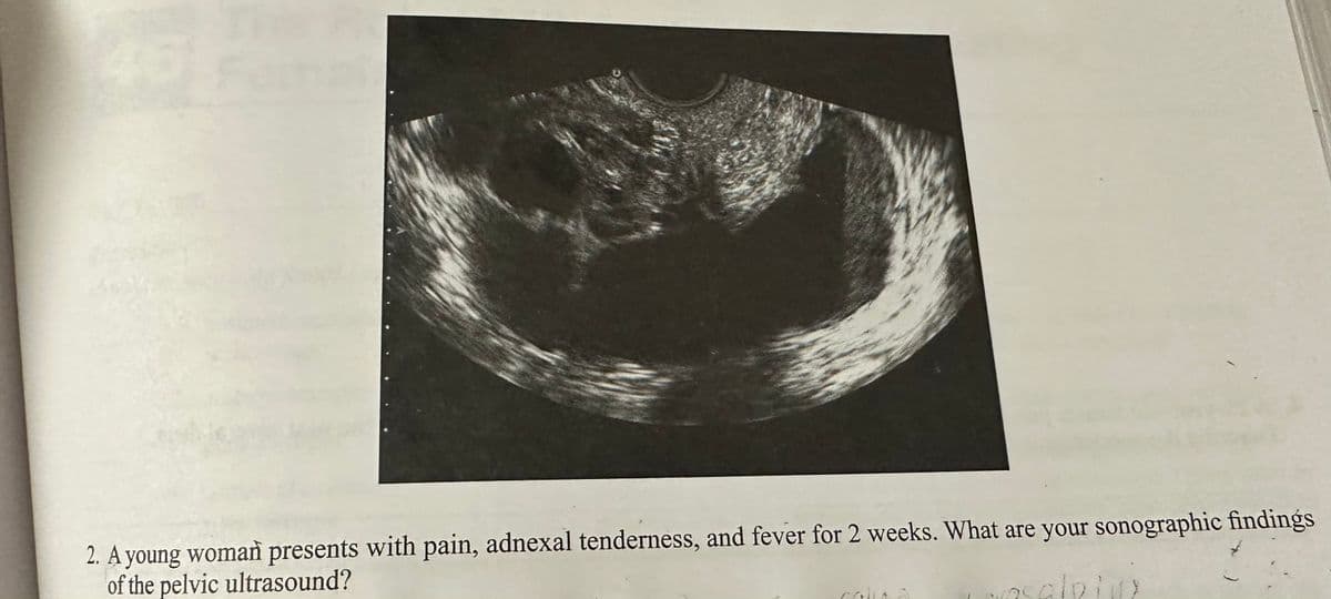 2. A young woman presents with pain, adnexal tenderness, and fever for 2 weeks. What are your sonographic findings
of the pelvic ultrasound?