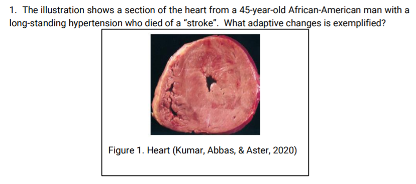 1. The illustration shows a section of the heart from a 45-year-old African-American man with a
long-standing hypertension who died of a "stroke". What adaptive changes is exemplified?
Figure 1. Heart (Kumar, Abbas, & Aster, 2020)
