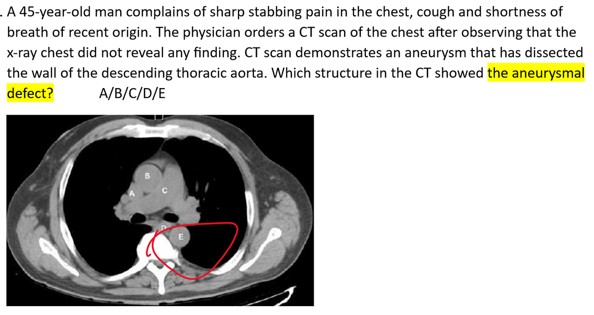 . A 45-year-old man complains of sharp stabbing pain in the chest, cough and shortness of
breath of recent origin. The physician orders a CT scan of the chest after observing that the
X-ray chest did not reveal any finding. CT scan demonstrates an aneurysm that has dissected
the wall of the descending thoracic aorta. Which structure in the CT showed the aneurysmal
defect?
A/B/C/D/E
E