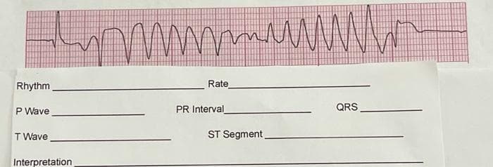 Rhythm
Rate
P Wave
PR Interval
QRS
T Wave
ST Segment
Interpretation
