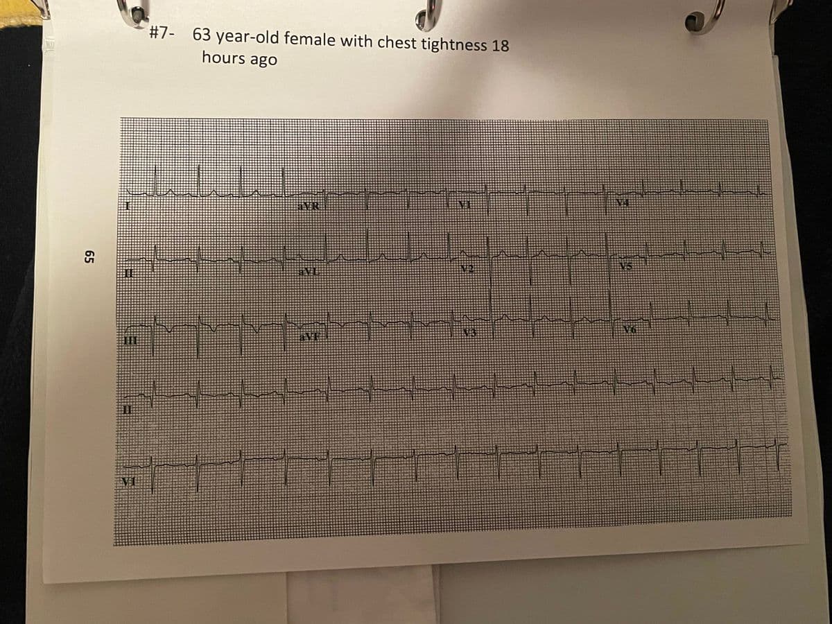 65
III
V1
#7- 63 year-old female with chest tightness 18
hours ago
M
MITT
AVI
SKAKELKKAS