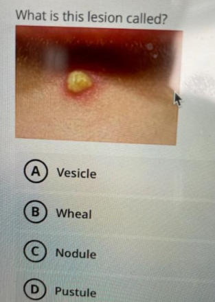 What is this lesion called?
A) Vesicle
(B) Wheal
C) Nodule
D
Pustule
