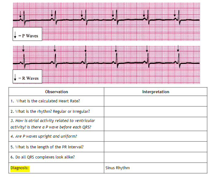 W
= P Waves
= R Waves
Observation
1. What is the calculated Heart Rate?
2. What is the rhythm? Regular or Irregular?
3. How is atrial activity related to ventricular
activity? Is there a P wave before each QRS?
4. Are P waves upright and uniform?
5. What is the length of the PR interval?
6. Do all QRS complexes look alike?
Diagnosis:
Sinus Rhythm
Interpretation