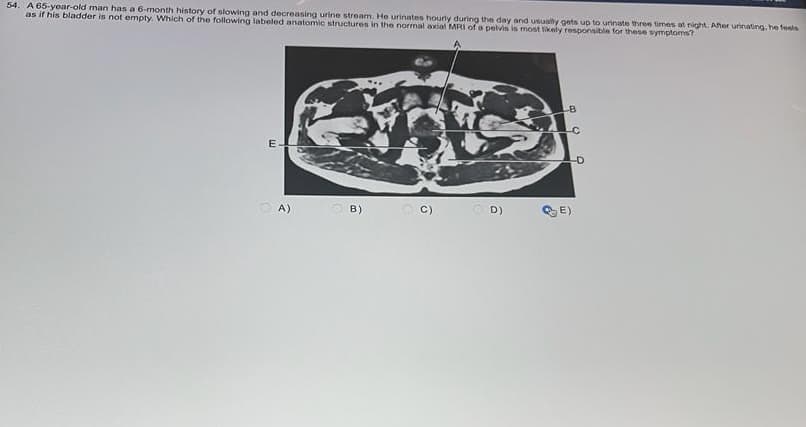 54. A 65-year-old man has a 6-month history of slowing and decreasing urine stream. He urinates hourly during the day and usually gets up to urinate three times at night. After urinating, he feels
as if his bladder is not empty. Which of the following labeled anatomic structures in the normal axial MRI of a pelvis is most likely responsible for these symptoms?
E
A)
B)
C)
OD)
B
-C
-D