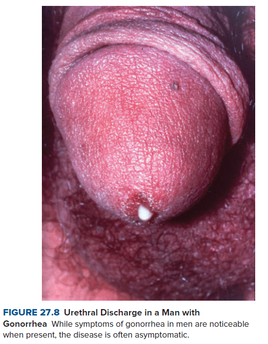 FIGURE 27.8 Urethral Discharge in a Man with
Gonorrhea While symptoms of gonorrhea in men are noticeable
when present, the disease is often asymptomatic.
