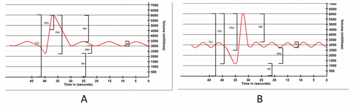 45
JLC
FEV₁
+
40
FVC
+
35
IRV
ERV
RV
25
30
Time in (seconds)
A
+
20
+
15
10
+
5
-7000
6500
6000
5500
5000
4500
4000
-3500
3000
2500
-2000
1500
1000
500
0
Volume (millilitres)
TLC
FVC
45 40
FEV₁
35
IRV
RV
25
30
Time in (seconds)
B
20
ERV
15
+
10
+
5
7000
6500
6000
5500
5000
4500
4000
3500
-3000
2500
2000
-1500
1000
500
0
Volume (millilitres)