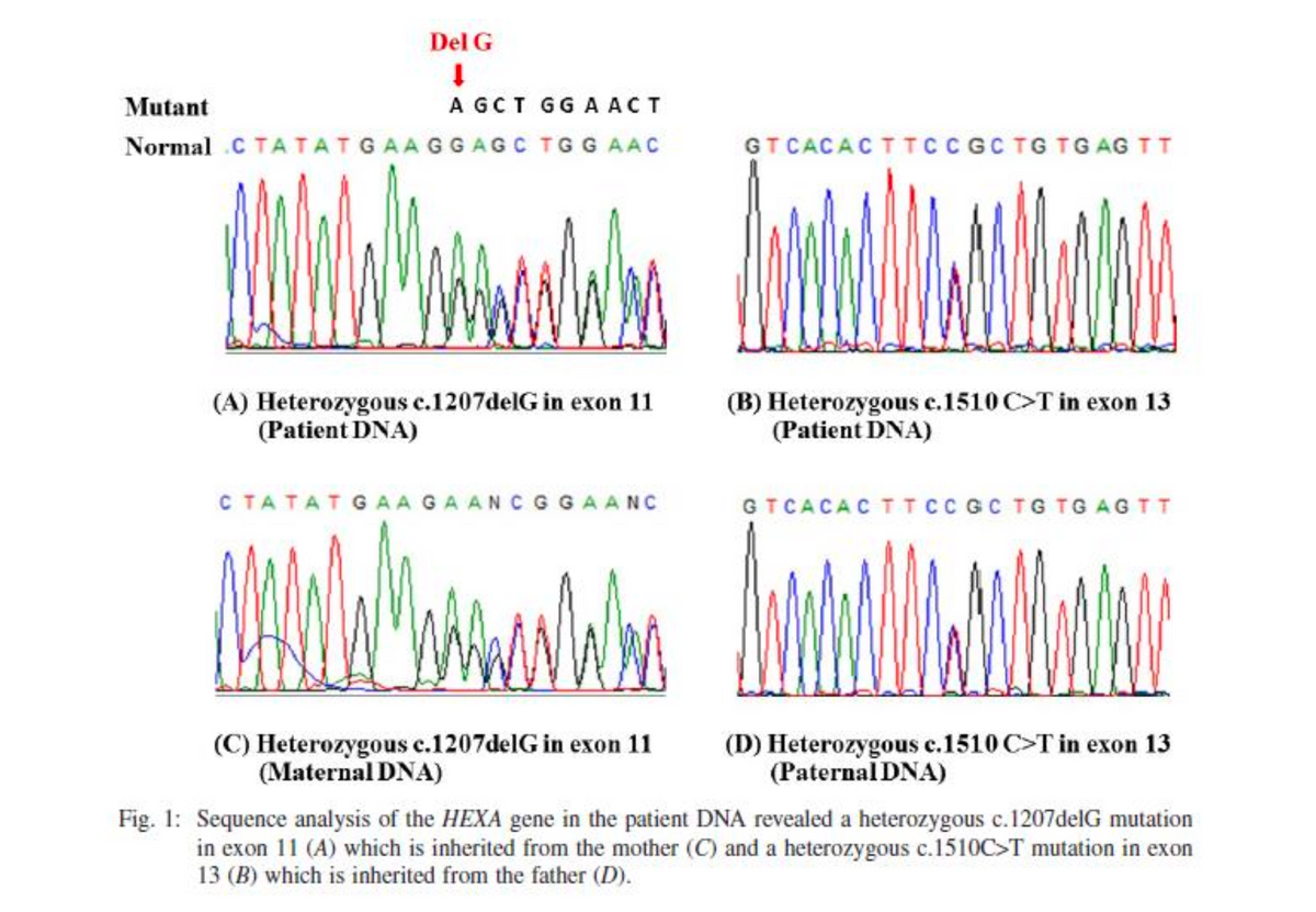 Del G
Mutant
A GCT GGA ACT
Normal CTATATGAAGGAGC TG GAAC
GTCACACTTCCGC TG TG AGTT
(A) Heterozygous c.1207delG in exon 11
(Patient DNA)
CTATATGAAGAANCGGAANC
(B) Heterozygous c.1510 C>T in exon 13
(Patient DNA)
GTCACACTTCC GC TG TG AGTT
(C) Heterozygous c.1207delG in exon 11
(Maternal DNA)
(D) Heterozygous c.1510 C>T in exon 13
(Paternal DNA)
Fig. 1: Sequence analysis of the HEXA gene in the patient DNA revealed a heterozygous c.1207delG mutation
in exon 11 (A) which is inherited from the mother (C) and a heterozygous c.1510C>T mutation in exon
13 (B) which is inherited from the father (D).