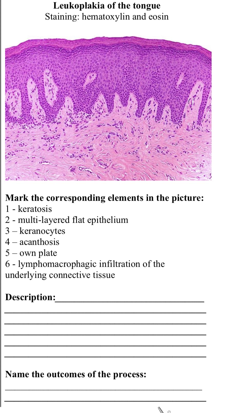 Leukoplakia of the tongue
Staining: hematoxylin and eosin
W
MAT
Mark the corresponding elements in the picture:
1 - keratosis
2 multi-layered flat epithelium
-
3 - keranocytes
4 - acanthosis
5 - own plate
6 - lymphomacrophagic infiltration of the
underlying connective tissue
Description:
Name the outcomes of the process:
0