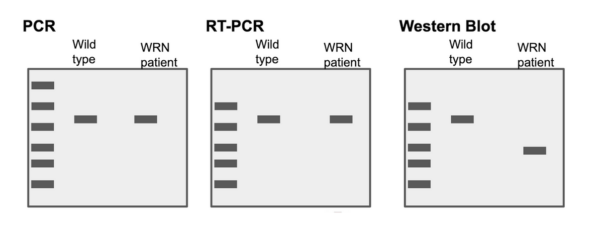 PCR
Wild
type
WRN
patient
RT-PCR
Wild
type
WRN
patient
Western Blot
Wild
type
WRN
patient