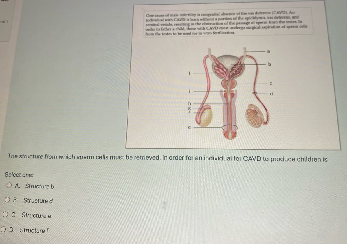 t of 1
One cause of male infertility is congenital absence of the vas deferens (CAVD). An
individual with CAVD is born without a portion of the epididymis, vas deferens, and
seminal vesicle, resulting in the obstruction of the passage of sperm from the testes. In
order to father a child, those with CAVD must undergo surgical aspiration of sperm cells
from the testes to be used for in vitro fertilization.
Select one:
OA. Structure b
OB. Structure d
OC. Structure e
OD. Structure f
你
b
d
The structure from which sperm cells must be retrieved, in order for an individual for CAVD to produce children is