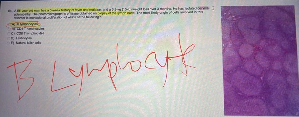 64. A 56-year-old man has a 3-week history of fever and malaise, and a 6.8-kg (15-lb) weight loss over 3 months. He has isolated cervical I
adenopathy. The photomicrograph is of tissue obtained on biopsy of the lymph node. The most likely origin of cells involved in this
disorder is monoclonal proliferation of which of the following?
A) B lymphocytes
B) CD4 T lymphocytes
OC) CD8 T lymphocytes
D) Histiocytes
E) Natural killer cells
B Lymphocyt