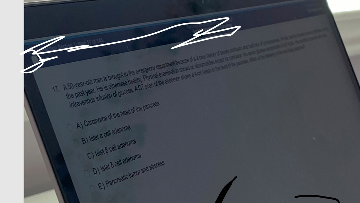 ction Section 1: Hem 17 of 145.
17. A 50-year-old man is brought to the emergency department because of a 2-hour history of severe confusion and trel cs of conec
the past year. He is otherwise healthy. Physical examination shows no abnormalities except for confusion. His serum gjuse concertation S
intravenous infusion of glucose. A CT scan of the abdomen shows a 4-cm lesion in the head of the pancreas. Which of the bowing the d
OA) Carcinoma of the head of the pancreas
B) Islet a cell adenoma
OC) Islet 3 cell adenoma
OD) Islet o cell adenoma
تھے
E) Pancreatic tumor and abscess