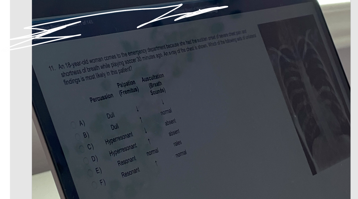 Z
11. An 18-year-old woman comes to the emergency department because she had the sudden onset of severe chest pain and
shortness of breath while playing soccer 30 minutes ago. An x-ray of the chest is shown. Which of the following sels of uniteral
findings is most likely in this patient?
of 145
OA)
Palpation
Percussion (Fremitus)
OB)
OC)
Dull
Dull
Hyperresonant
Hyperresonant
Resonant
Resonant
D)
OE)
OF)
Auscultation
(Breath
Sounds)
normal
normal
absent
absent
rales
normal