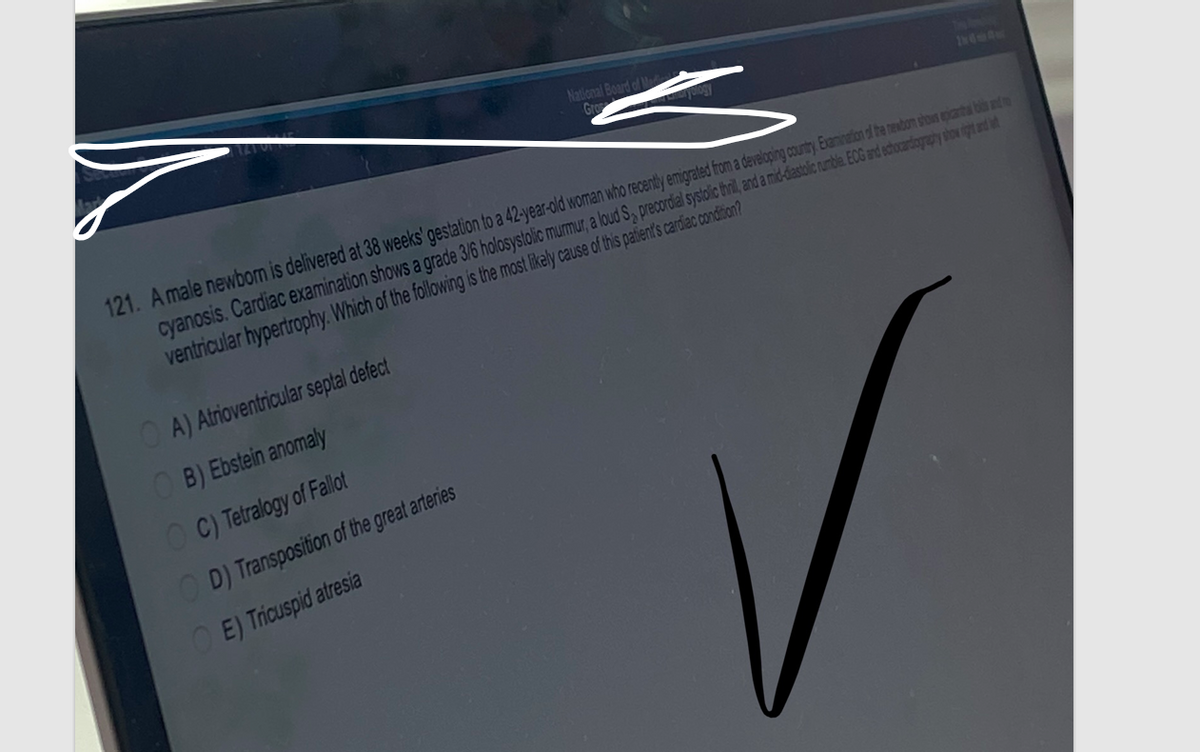121. A male newborn is delivered at 38 weeks' gestation to a 42-year-old woman who recently emigrated from a developing country. Examination of the newbom shows epizanthal bisa and to
cyanosis. Cardiac examination shows a grade 3/6 holosystolic murmur, a loud S, precordial systolic thrill, and a mid-diastolic rumble. ECG and echocardiography show right and int
ventricular hypertrophy. Which of the following is the most likely cause of this patient's cardiac condition?
A) Atrioventricular septal defect
National Board of Ma
Gro
OB) Ebstein anomaly
C) Tetralogy of Fallot
OD) Transposition of the great arteries
OE) Tricuspid atresia