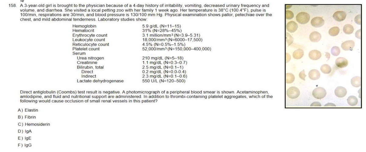 158. A 3-year-old girl is brought to the physician because of a 4-day history of irritability, vomiting, decreased urinary frequency and
volume, and diarrhea. She visited a local petting zoo with her family 1 week ago. Her temperature is 38°C (100.4°F), pulse is
100/min, respirations are 30/min, and blood pressure is 130/100 mm Hg. Physical examination shows pallor, petechiae over the
chest, and mild abdominal tenderness. Laboratory studies show:
A) Elastin
B) Fibrin
Hemoglobin
Hematocrit
C) Hemosiderin
D) IgA
E) IgE
F) IgG
Erythrocyte count
Leukocyte count
Reticulocyte count
Platelet count
Serum
Urea nitrogen
Creatinine
Bilirubin, total
Direct
Indirect
Lactate dehydrogenase
5.9 g/dL (N=11-15)
31% (N=28% -45%)
3.1 million/mm³ (N=3.9-5.31)
18,000/mm³ (N=6000-17,500)
4.5% (N=0.5% -1.5%)
52,000/mm³ (N=150,000-400,000)
Direct antiglobulin (Coombs) test result is negative. A photomicrograph of a peripheral blood smear is shown. Acetaminophen,
amlodipine, and fluid and nutritional support are administered. In addition to thrombi-containing platelet aggregates, which of the
following would cause occlusion of small renal vessels in this patient?
210 mg/dL (N=5-18)
1.1 mg/dL (N=0.3-0.7)
2.5 mg/dL (N=0.1-1)
0.2 mg/dL (N=0.0-0.4)
2.3 mg/dL (N=0.1-0.6)
550 U/L (N=120-500)
