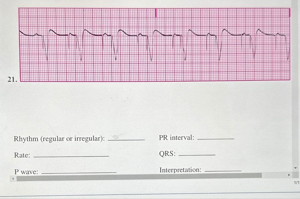 21.
Rhythm (regular or irregular):
Rate:
P wave:
PR interval:
QRS:
Interpretation:
1/1