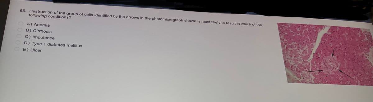 65. Destruction of the group of cells identified by the arrows in the photomicrograph shown is most likely to result in which of the
following conditions?
A) Anemia
B) Cirrhosis
C) Impotence
D) Type 1 diabetes mellitus
E) Ulcer