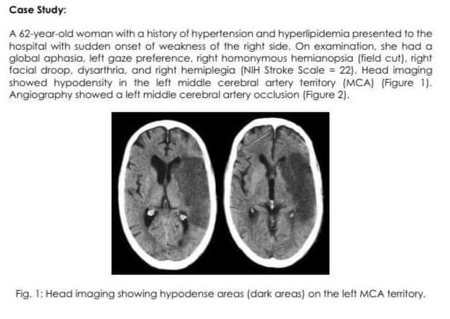 Case Study:
A 62-year-old woman with a history of hypertension and hyperlipidemia presented to the
hospital with sudden onset of weakness of the right side. On examination, she had a
global aphasia, left gaze preference, right homonymous hemianopsia (field cut), right
facial droop, dysarthria, and right hemiplegia (NIH Stroke Scale = 22). Head imaging
showed hypodensity in the left middle cerebral artery territory (MCA) (Figure 1).
Angiography showed a left middle cerebral artery occlusion (Figure 2).
Fig. 1: Head imaging showing hypodense areas (dark areas) on the left MCA territory.