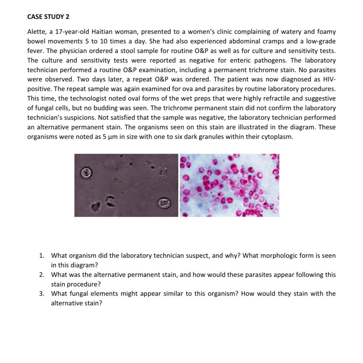 CASE STUDY 2
Alette, a 17-year-old Haitian woman, presented to a women's clinic complaining of watery and foamy
bowel movements 5 to 10 times a day. She had also experienced abdominal cramps and a low-grade
fever. The physician ordered a stool sample for routine O&P as well as for culture and sensitivity tests.
The culture and sensitivity tests were reported as negative for enteric pathogens. The laboratory
technician performed a routine O&P examination, including a permanent trichrome stain. No parasites
were observed. Two days later, a repeat O&P was ordered. The patient was now diagnosed as HIV-
positive. The repeat sample was again examined for ova and parasites by routine laboratory procedures.
This time, the technologist noted oval forms of the wet preps that were highly refractile and suggestive
of fungal cells, but no budding was seen. The trichrome permanent stain did not confirm the laboratory
technician's suspicions. Not satisfied that the sample was negative, the laboratory technician performed
an alternative permanent stain. The organisms seen on this stain are illustrated in the diagram. These
organisms were noted as 5 μm in size with one to six dark granules within their cytoplasm.
1. What organism did the laboratory technician suspect, and why? What morphologic form is seen
in this diagram?
2. What was the alternative permanent stain, and how would these parasites appear following this
stain procedure?
3. What fungal elements might appear similar to this organism? How would they stain with the
alternative stain?