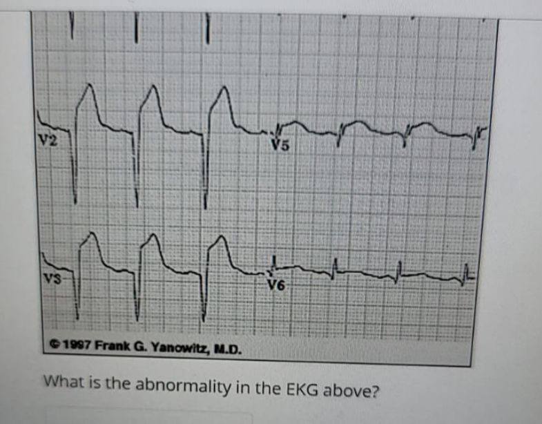 V2
V5
VS
V6
© 1997 Frank G. Yanowitz, M.D.
What is the abnormality in the EKG above?
