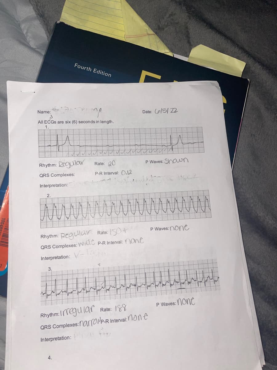 Fourth Edition
Name:
ing
All ECGs are six (6) seconds in length.
1.
M
Rhythm: Degular
Rate: 20
QRS Complexes:
P-R Interval: 0.12
Interpretation:
2.
N
V W
Rhythm: Regular Rate: 150+
QRS Complexes: Wide P-R Interval: none
Interpretation: V-s
↑
3.
we PW m
WIM
he
for
Rhythm: Irregular Rate: 188
QRS Complexes:narrowP-R Interval:none
Interpretation:
4.
Date: 6/5/22
u
P Waves: Shown
ww
Type 2
P Waves: none
WY
P Waves: none