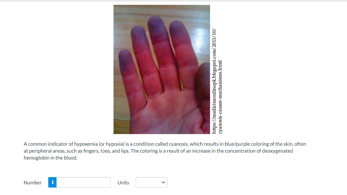 Number i
https://medicineonlinepk.blogspot.com/2013/10/
A common indicator of hypoxemia (or hypoxia) is a condition called cyanosis, which results in blue/purple coloring of the skin, often
at peripheral areas, such as fingers, toes, and lips. The coloring is a result of an increase in the concentration of deoxygenated
hemoglobin in the blood.
Units
cyanosis-causes-mechanisms.html